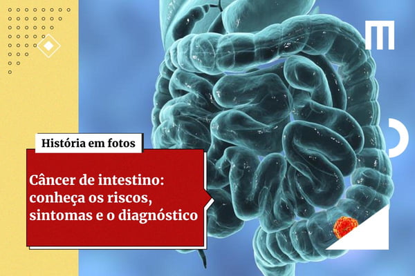 Câncer de intestino: anti-inflamatório pode reduzir risco de recidiva