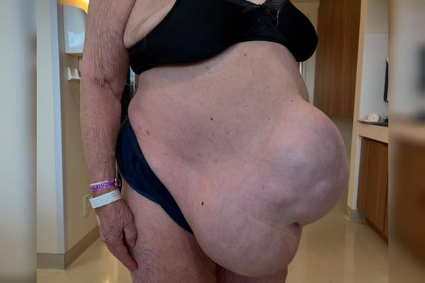 “Não queriam operar”, diz mulher que ficou com hérnia por 13 anos